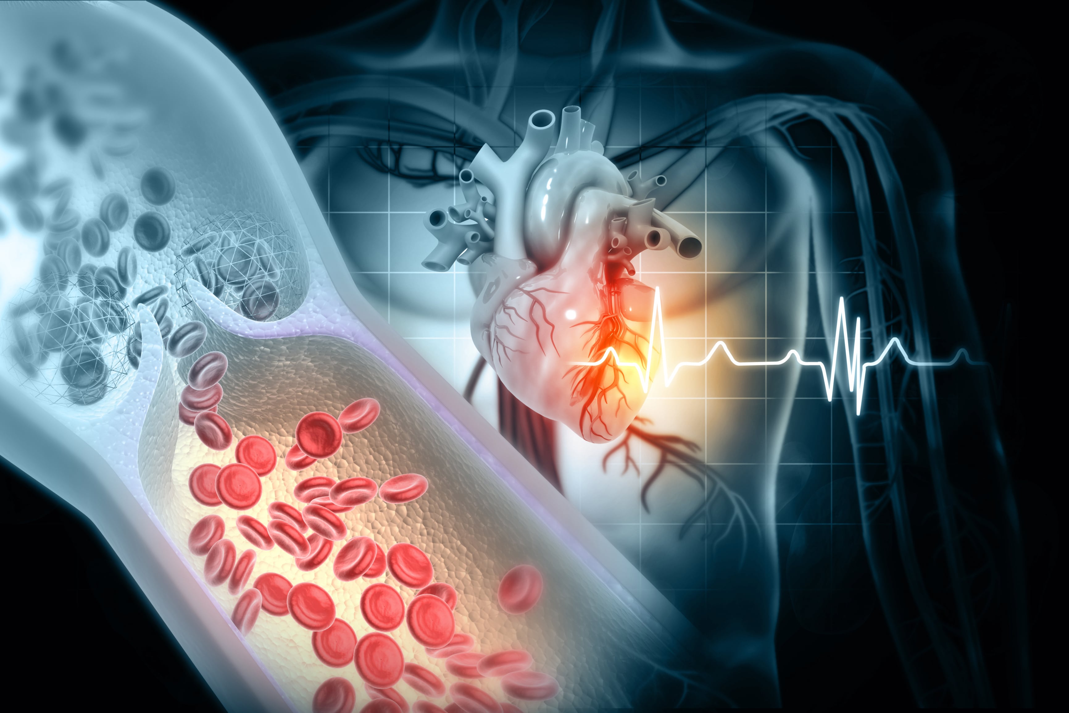 Cholesterol blocked artery with human heart. 3d illustration