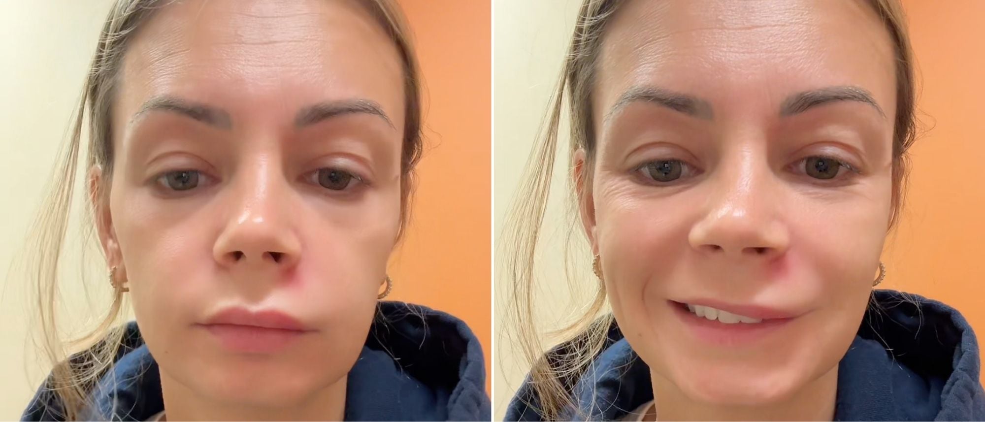 Woman squeezes pimples in