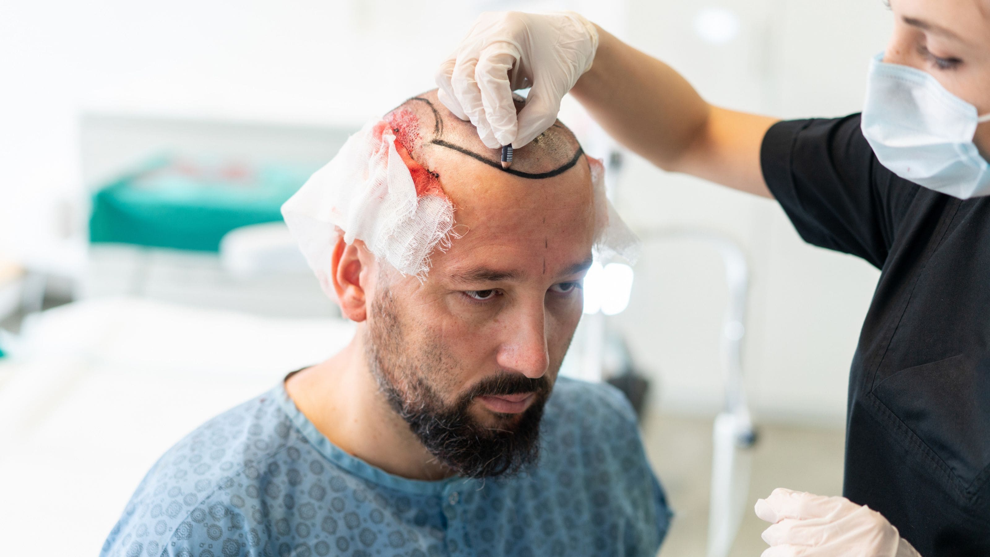 Świeżo zoperowane głowy z bandażami, opuchlizną i strupami: przeszczepy włosów coraz częściej pokazywane są otwarcie na TikToku.