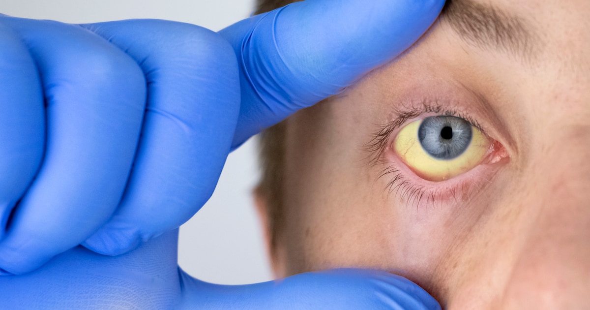 Hepatitis C: Was sind die Ursachen und Behandlungsmöglichkeiten?