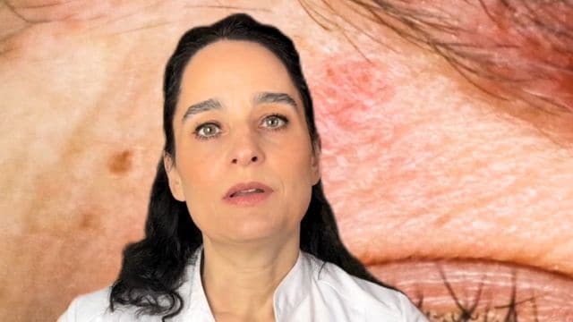 Yüzdeki zona özellikle tehlikelidir: Dermatolog ne yapılması gerektiğini açıklıyor