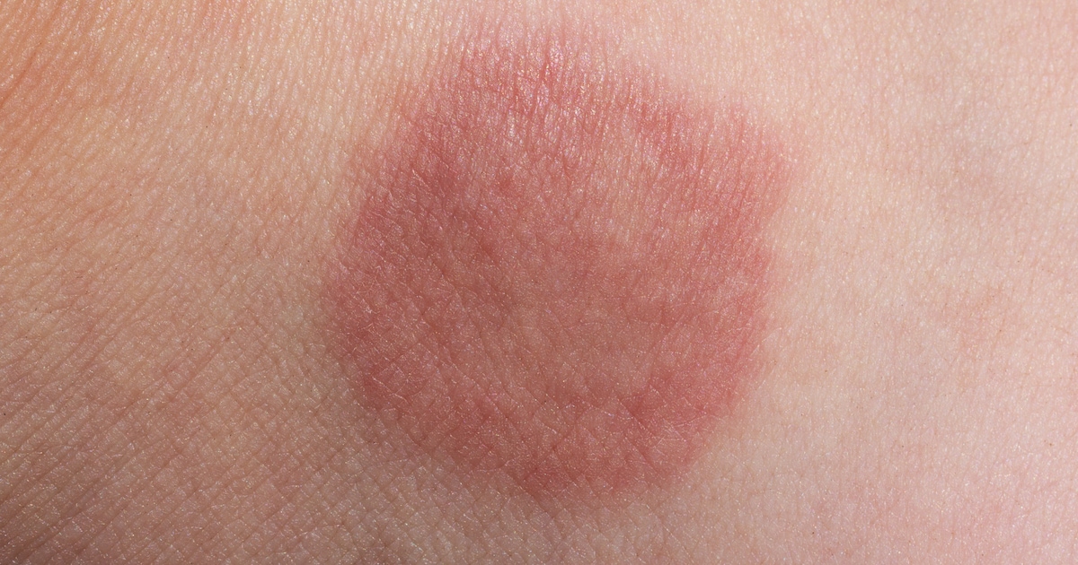 Erythrasma: Ursachen und Behandlung