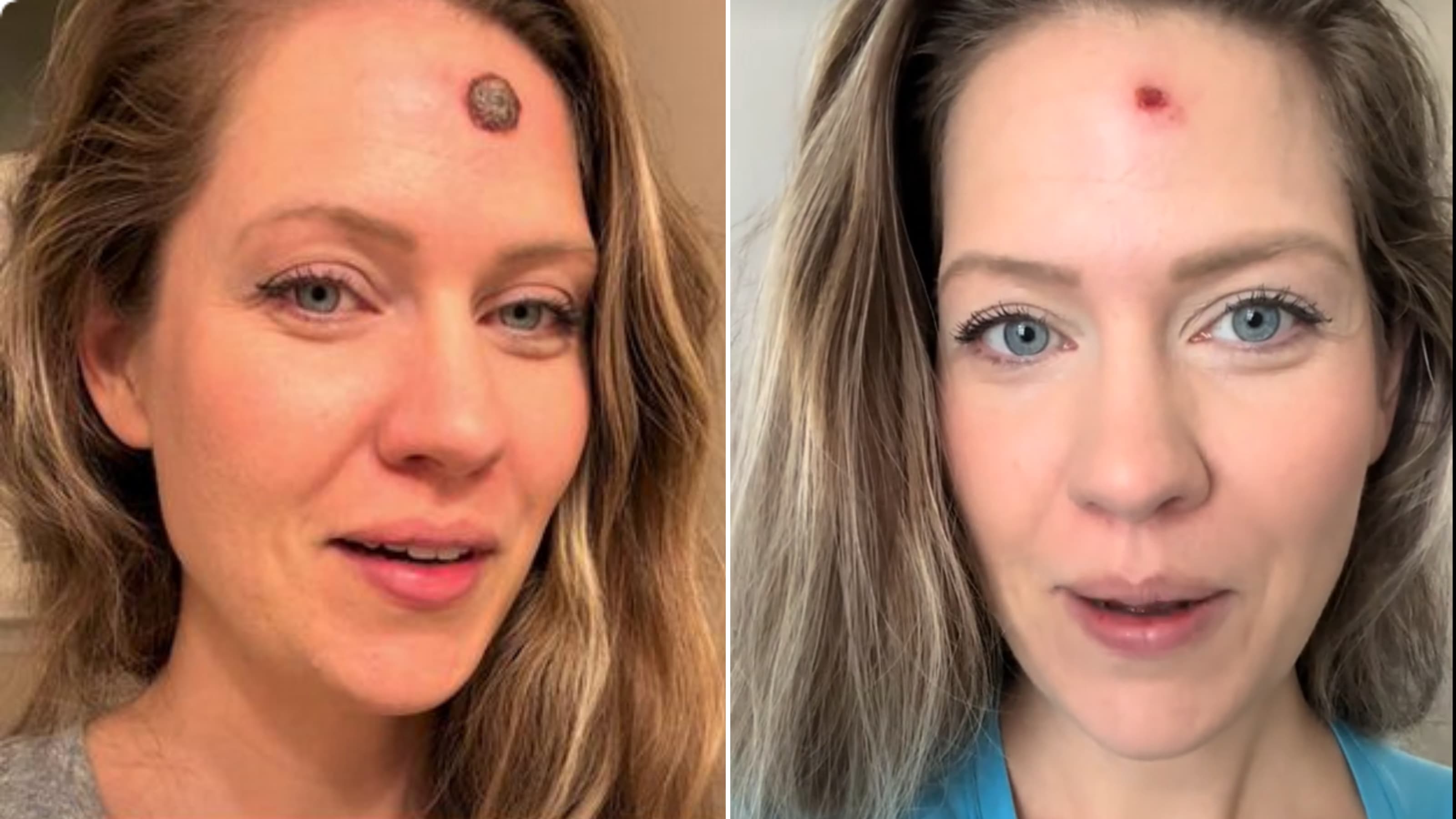 Rachel Archer pensait au départ qu’il s’agissait d’un bouton inoffensif, mais il s’agissait en fait d’un cancer de la peau.